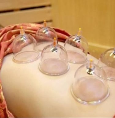 Cupping therapy