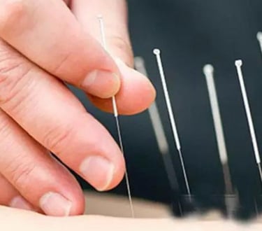 Acupuncture needles
